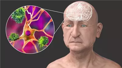 خَرَف أجسام ليوي مرض عصبي لا يعرفه الكثيرين روبين ويليامز كان مصاباً به ماذا تعرف عنه؟