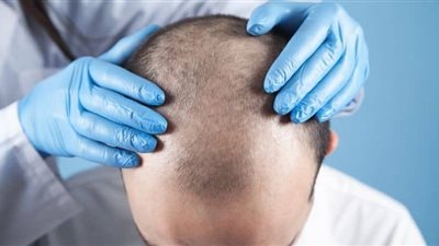 زراعة الشعر فوائد و أضرار و آلية العمل