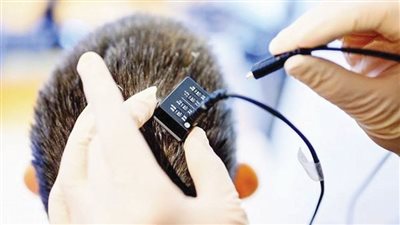نقلة نوعية في الطب.. شريحة تترجم إشارات الدماغ إلى كلام فوري