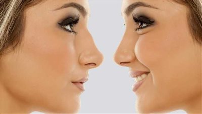 تجميل الانف بدون جراحة، حقق حلمك الجمالي