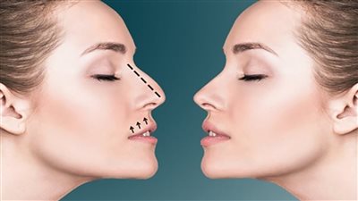 مضاعفات تجميل الانف ما يجب معرفته