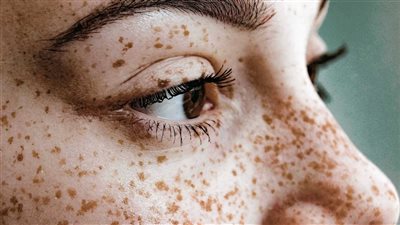 هل النمش مشكلة حقيقية؟ خمس خرافات شائعة يجب التوقف عن تصديقها