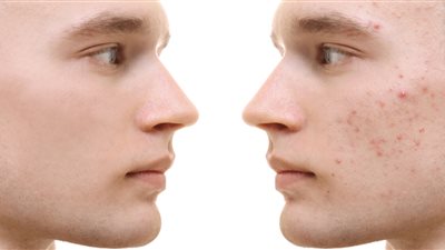 ماذا تفعل عندما تواجه مشكلة حب الشباب؟