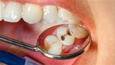 هل يمكنك علاج تسوس الأسنان؟